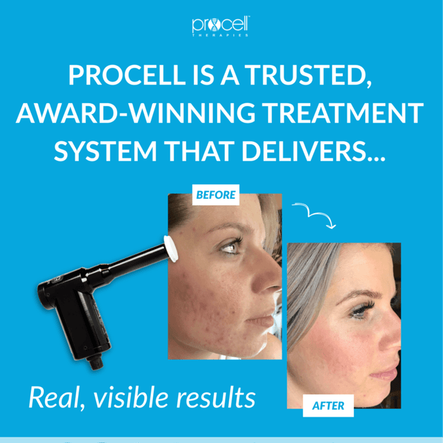 Procell Microchanneling 4+ at Inner Glo Skincare in Myrtle Beach, SC